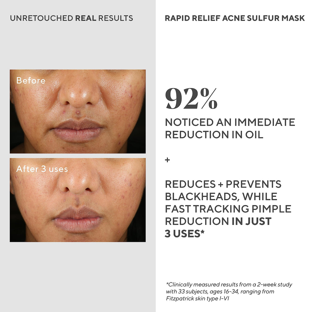 Murad Rapid Relief Acne Sulfur Mask – 5% Sulfur & Salicylic Acid, Austrian Peat, Clay Mask (2.5 oz)