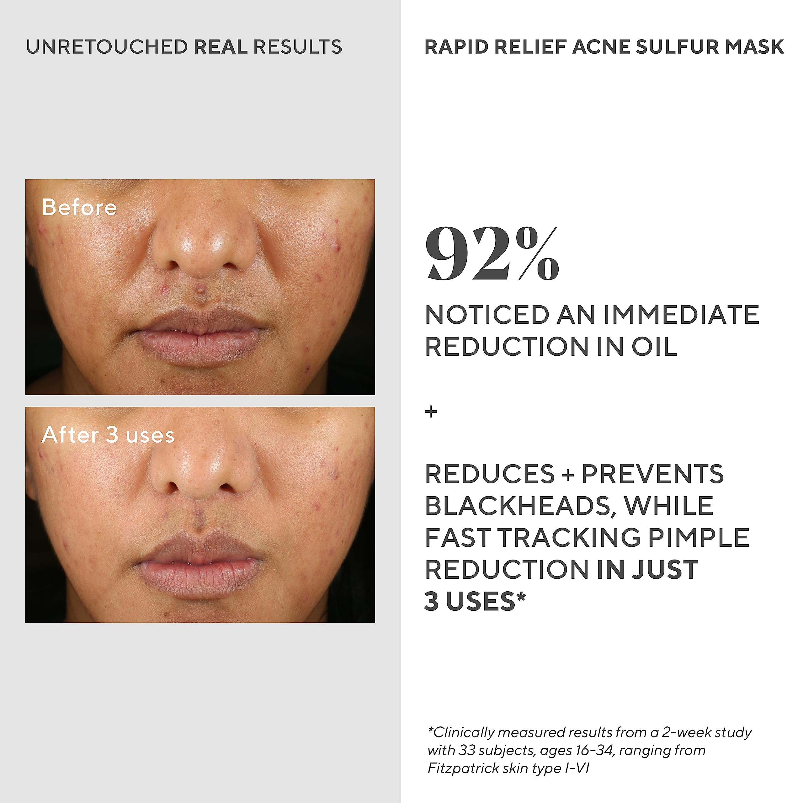 Murad Rapid Relief Acne Sulfur Mask – 5% Sulfur & Salicylic Acid, Austrian Peat, Clay Mask (2.5 oz)