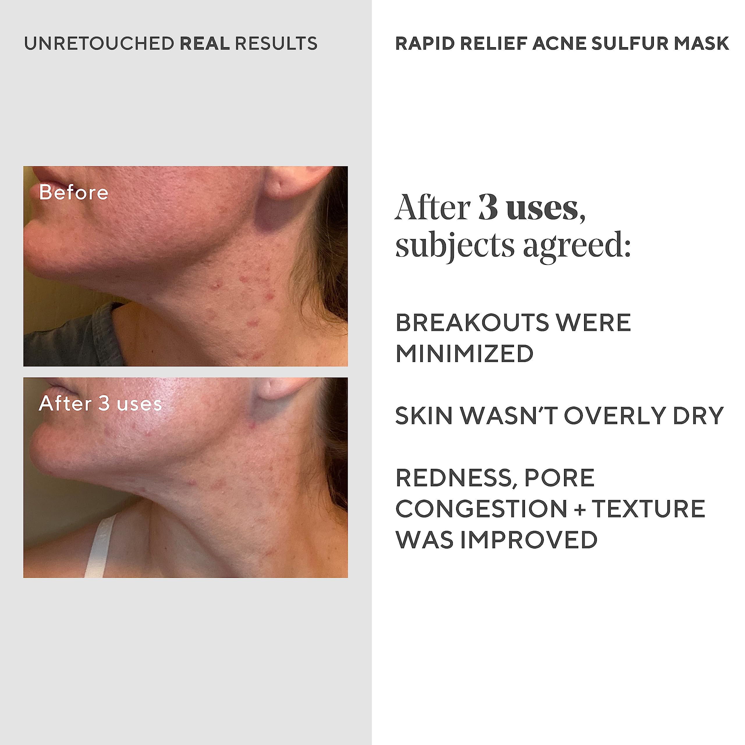 Murad Rapid Relief Acne Sulfur Mask – 5% Sulfur & Salicylic Acid, Austrian Peat, Clay Mask (2.5 oz)