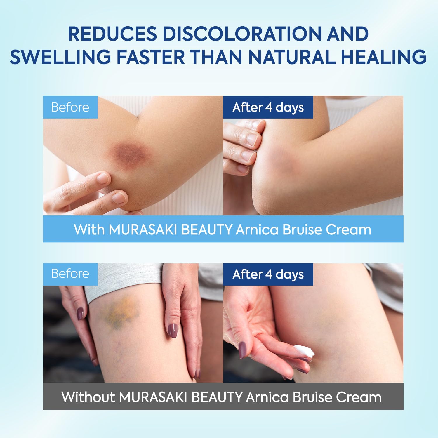MURASAKI BEAUTY Arnica Bruise Cream Extra Strength – Sensitive Skin, Vitamins K, C and E, 4oz