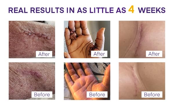 MURASAKI BEAUTY Silicone Scar Gel SPF 30 – Advanced Medical-Grade Scar Cream 1.06oz