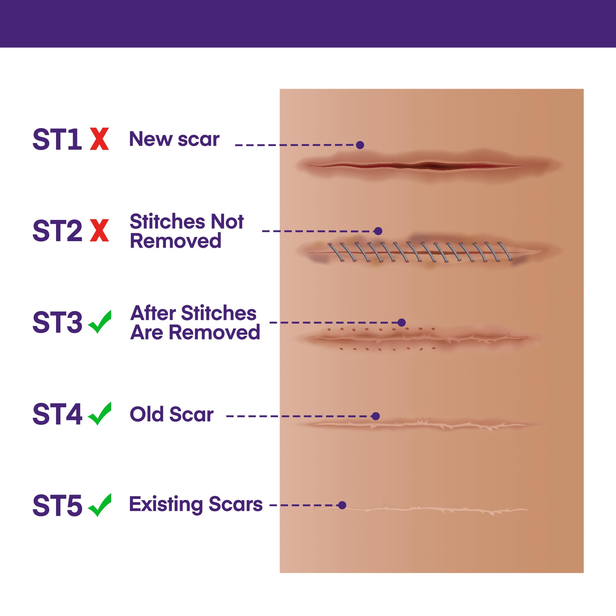 MURASAKI BEAUTY Silicone Scar Gel SPF 30 – Advanced Medical-Grade Scar Cream 1.06oz