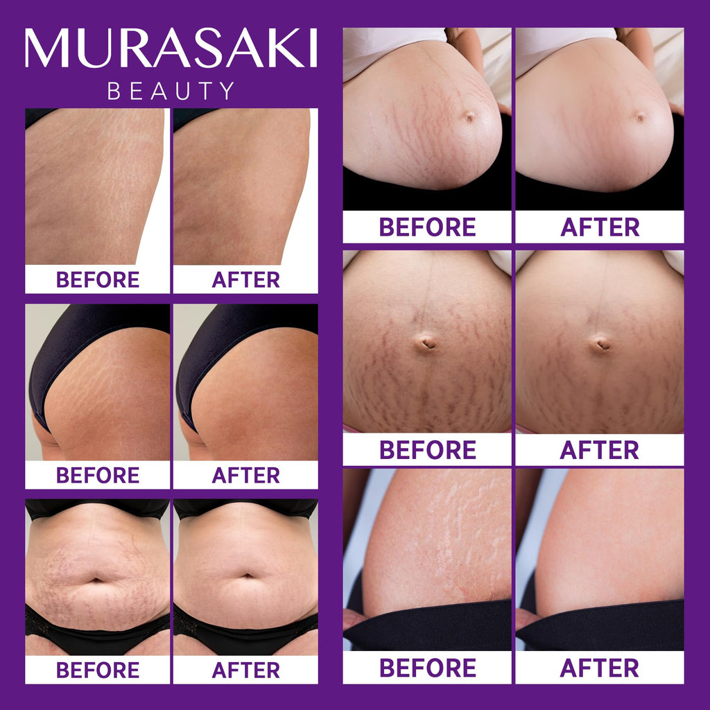 Murasaki Beauty Stretch Mark Cream for Pregnancy – 2 Pack Maternity Cream for Prevention & Elasticity (4 oz)