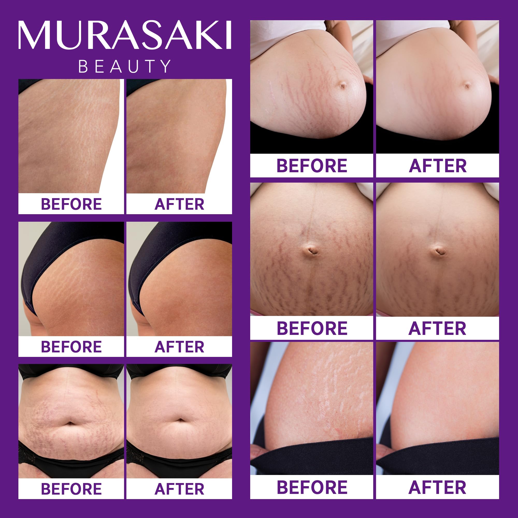 Murasaki Beauty Stretch Mark Cream for Pregnancy – 2 Pack Maternity Cream for Prevention & Elasticity (4 oz)