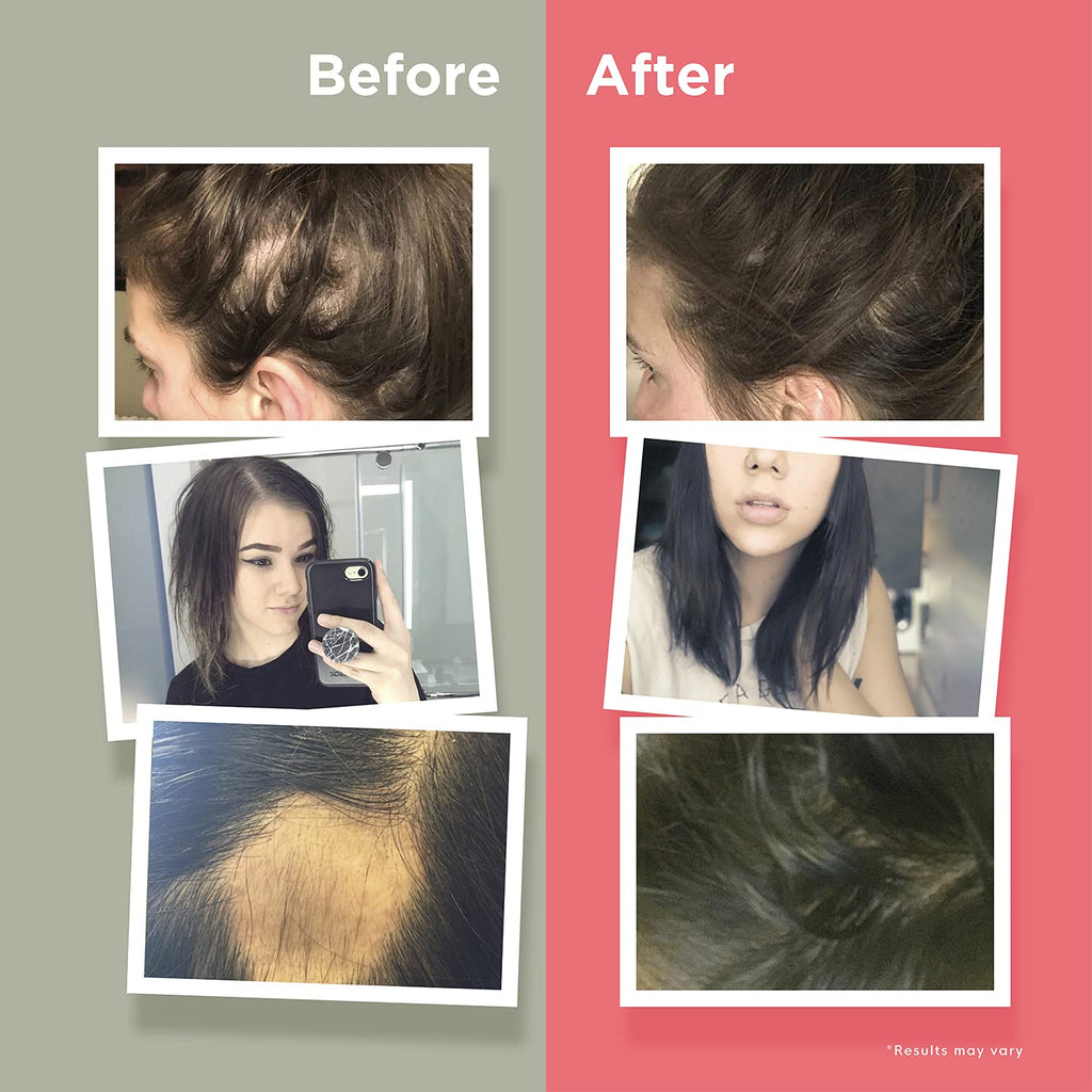 Naturenetics HairAnew Hair Growth Vitamins for Women & Men – Vegan Hair Supplement