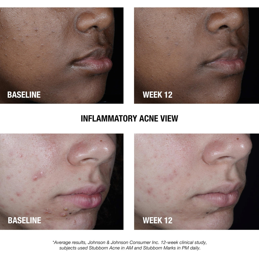 Neutrogena Stubborn Acne AM Treatment | 2.5% Benzoyl Peroxide, Oil-Free