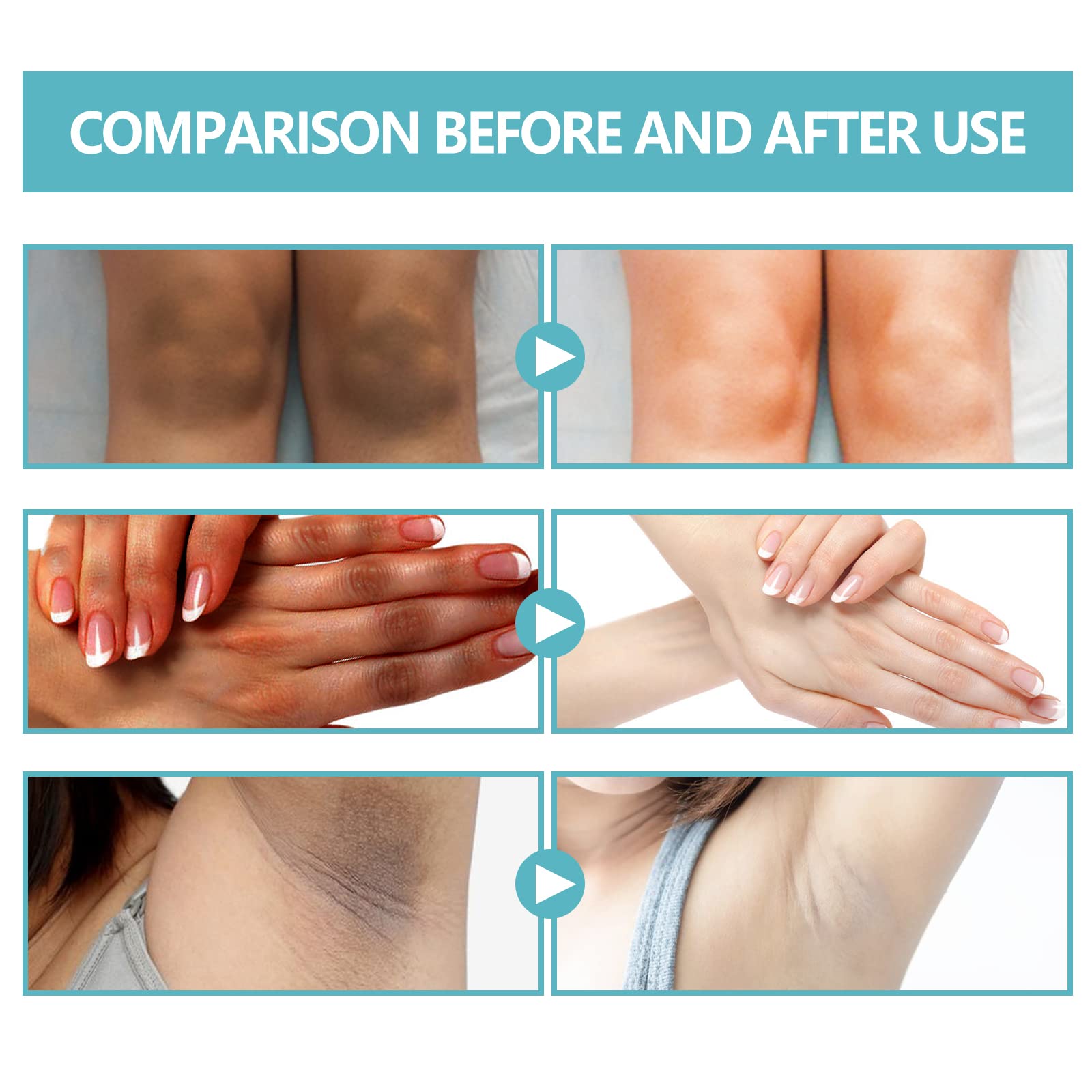 Nigrifix Acanthosis Nigricans Therapy Cream – Dark Spot Corrector for Body | Underarms, Neck & More | 2.1 Fl Oz