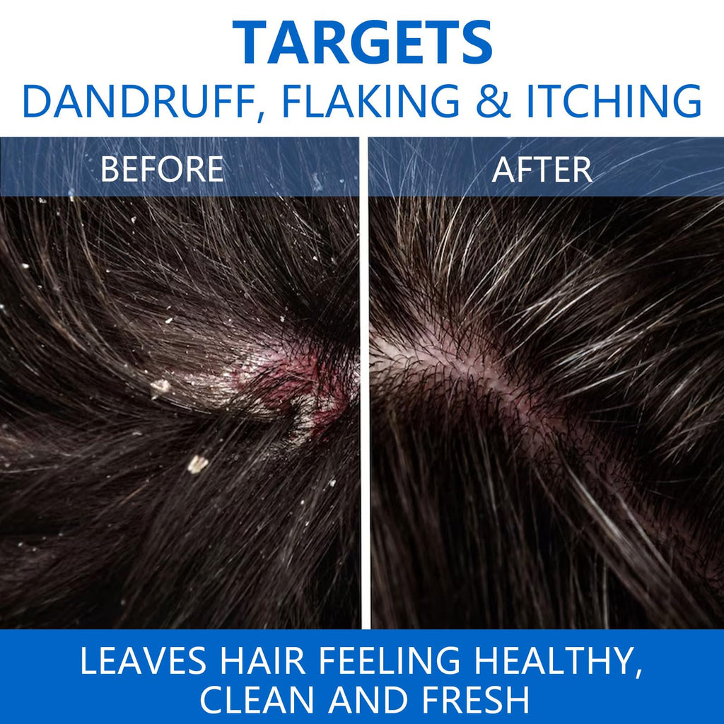 NIPPORI 300ML Selenium Disulfide Anti-Dandruff Shampoo - Oil Control for Men & Women