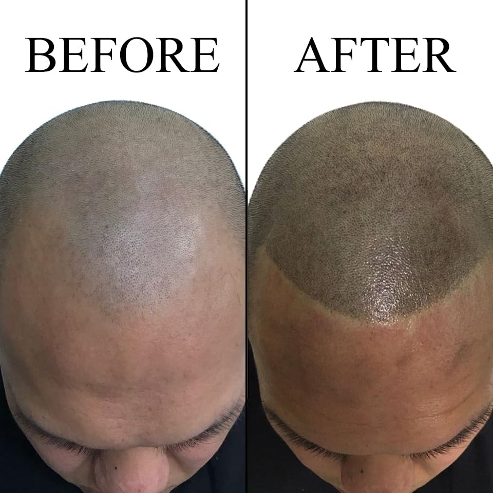 Nuva Follifill SMP Pigment Kit – Deepest Scalp Micropigmentation Ink, 15ml, 50+ Treatments, Includes Mixer & Diluting Chart