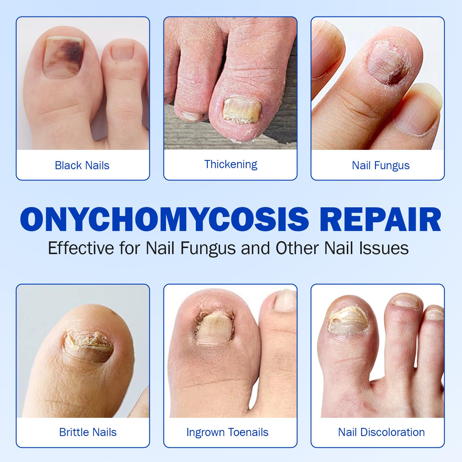 Nyloriaine Fungal Nail Patches - Extra Strength Toe Nail Repair (21p)