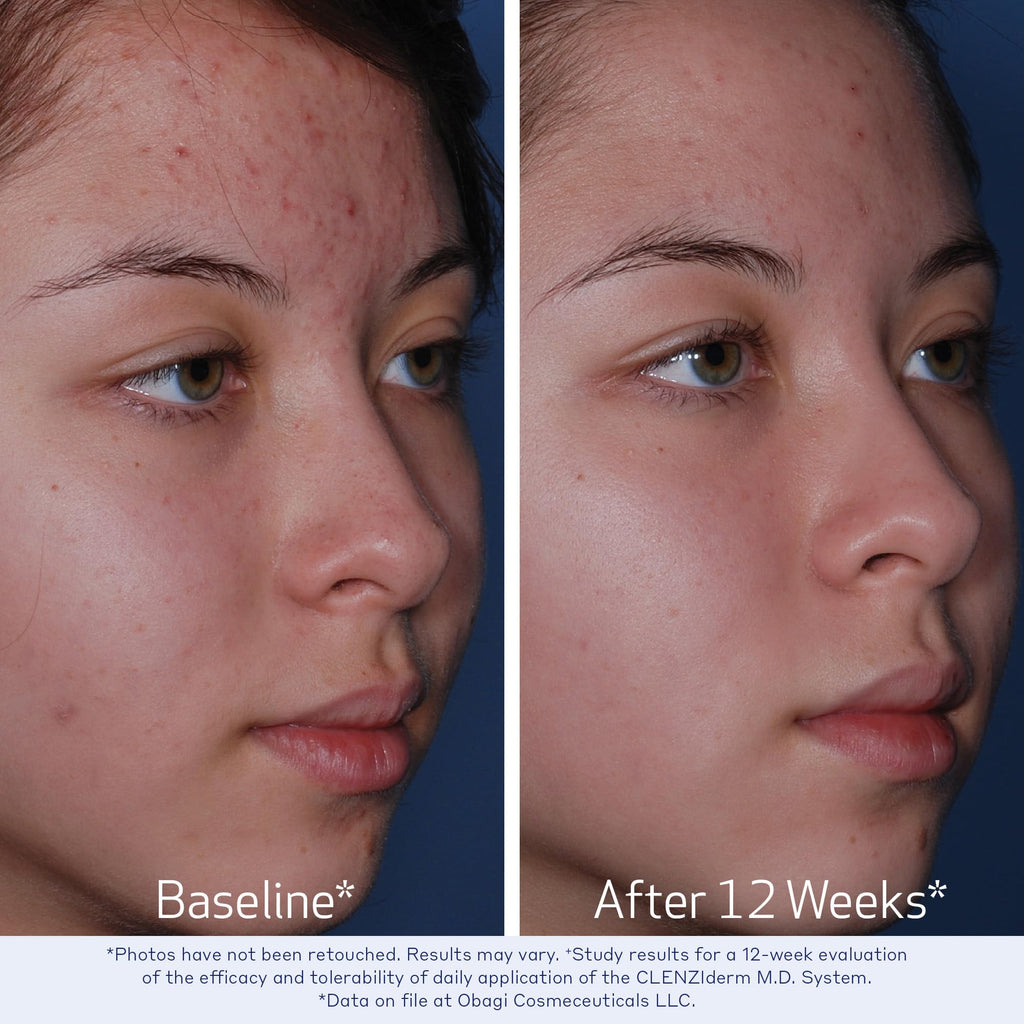 Obagi CLENZIderm M.D. Therapeutic System – 3 Step Acne Treatment with 2% BHA Cleanser, 2% BHA Toner, 5% BPO