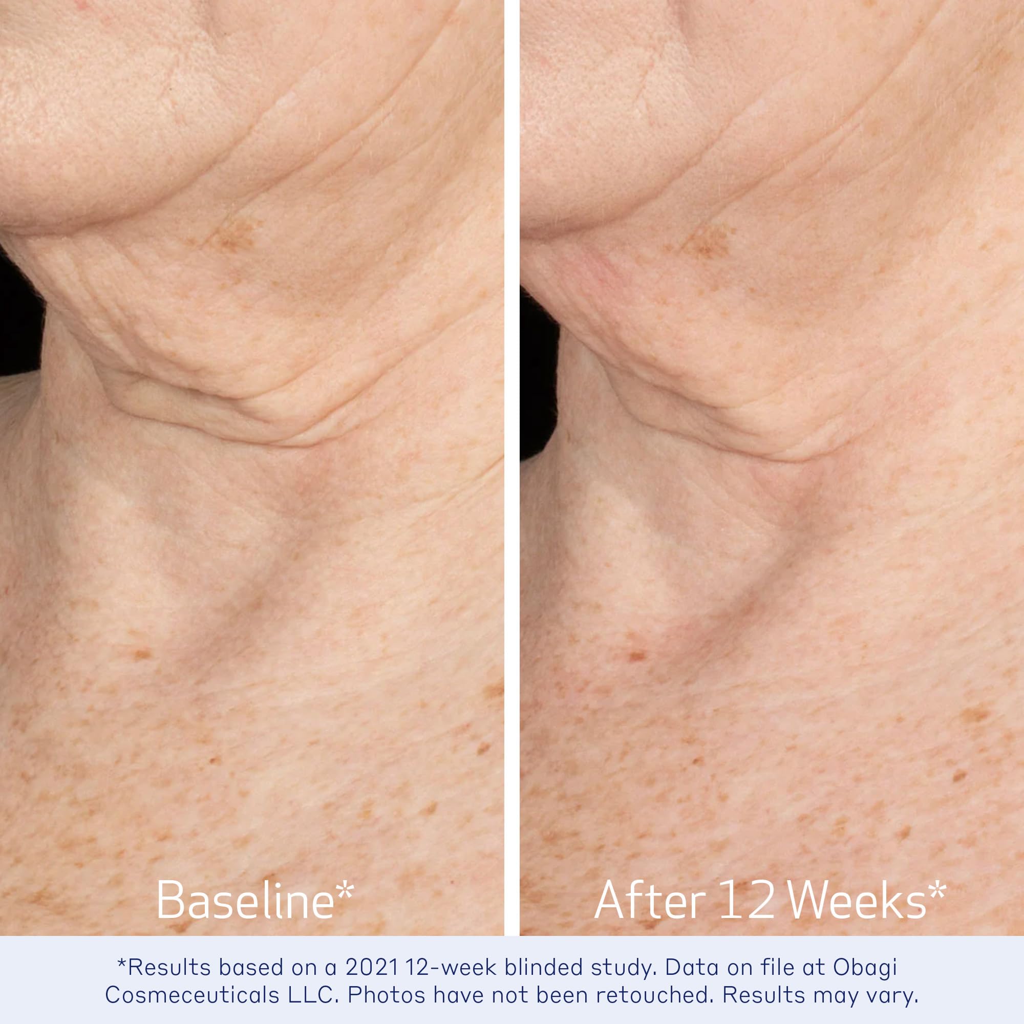 Obagi ELASTIderm Neck & Décolleté Lifting Concentrate – Bi-Mineral Contour Complex, Retinoid & Alpha-Arbutin, 2 oz