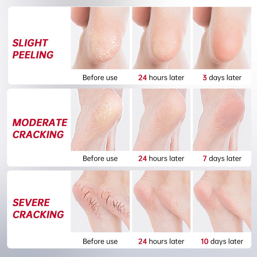 OCSINL Urea Cream 40% for Feet – Deep Repair, Moisture & Free Heel Covers (5.29 oz)