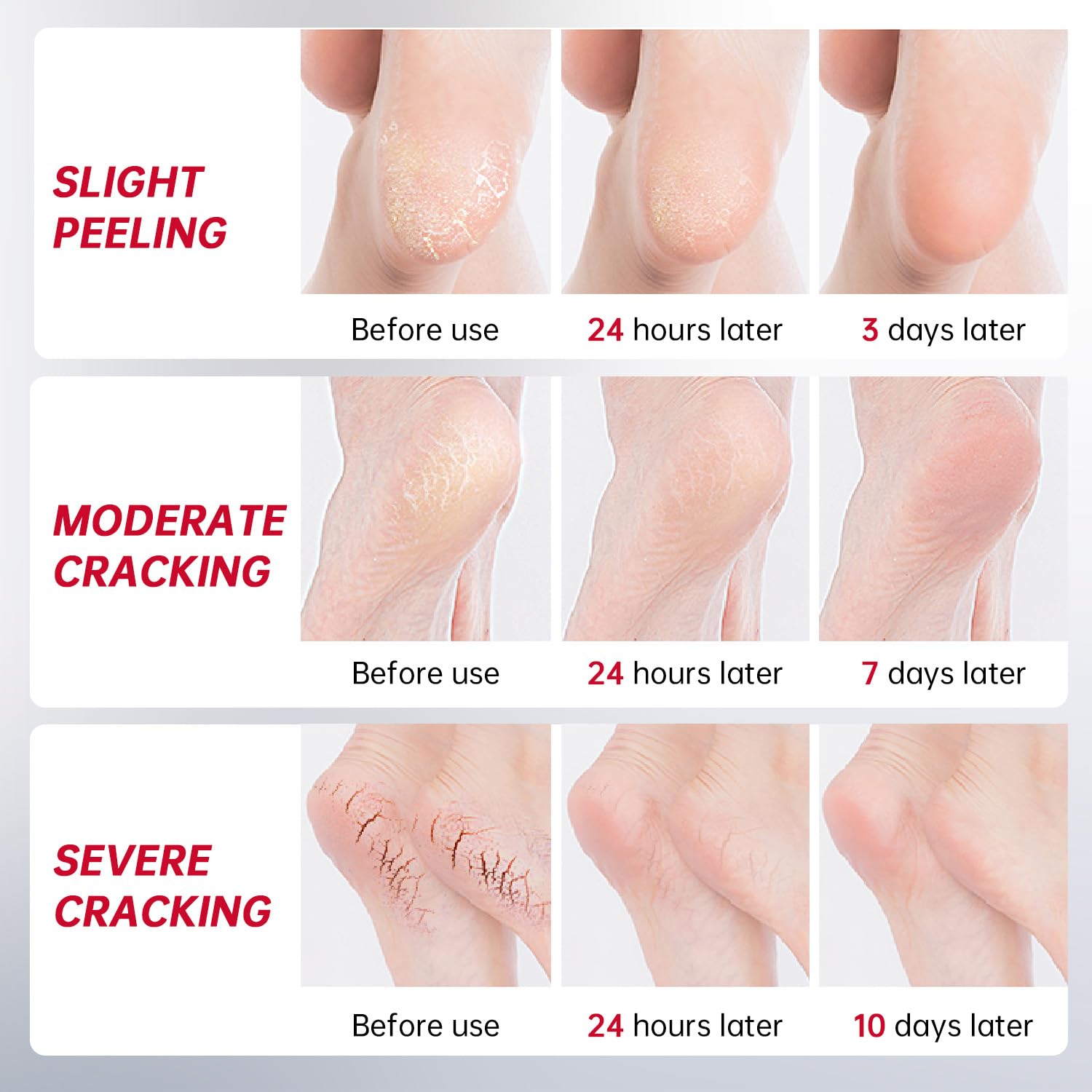 OCSINL Urea Cream 40% for Feet – Deep Repair, Moisture & Free Heel Covers (5.29 oz)