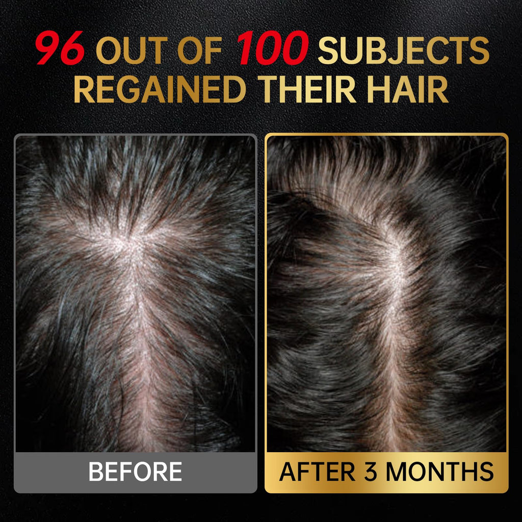 OCSINL 5% Minoxidil for Hair Regrowth — Biotin, Rosemary & Batana Oil (3-Pack)