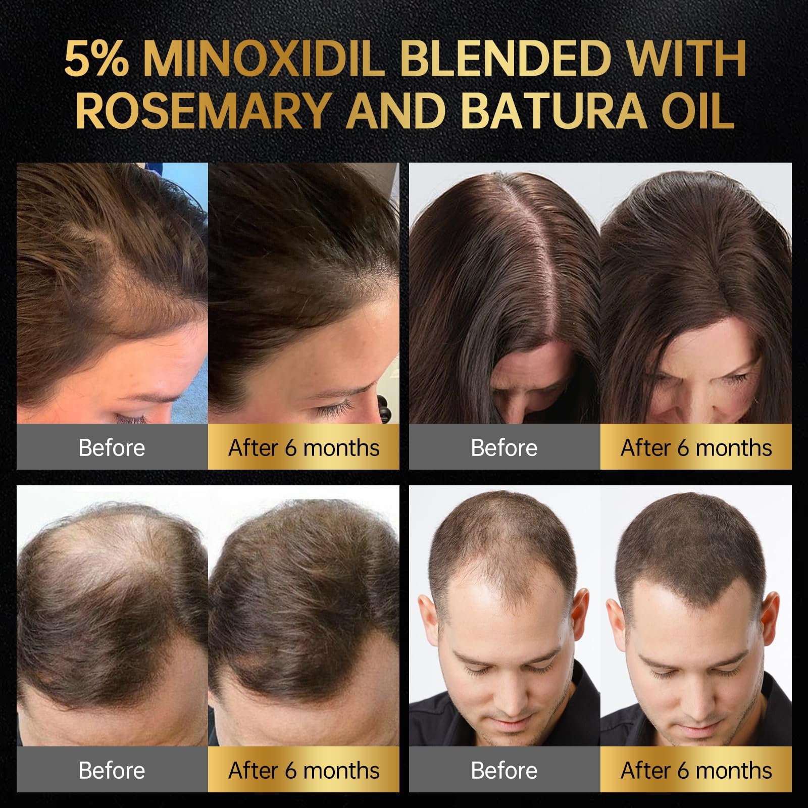 OCSINL Minoxidil 5% Serum + Massager Set for Men & Women – Hair Regrowth Solution with Biotin, Rosemary & Batana Oil (60ml)