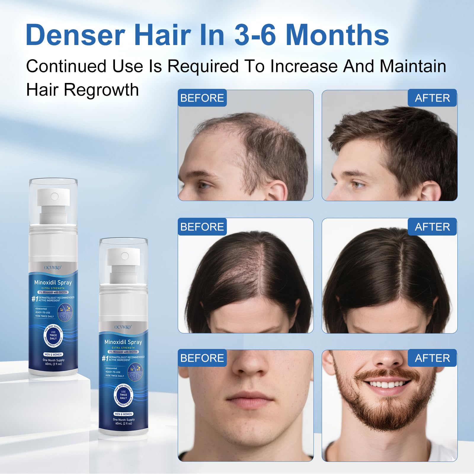 OCVWJKD 5% Minoxidil Spray for Hair Regrowth — Extra Strength 60ml x 7 Bottles