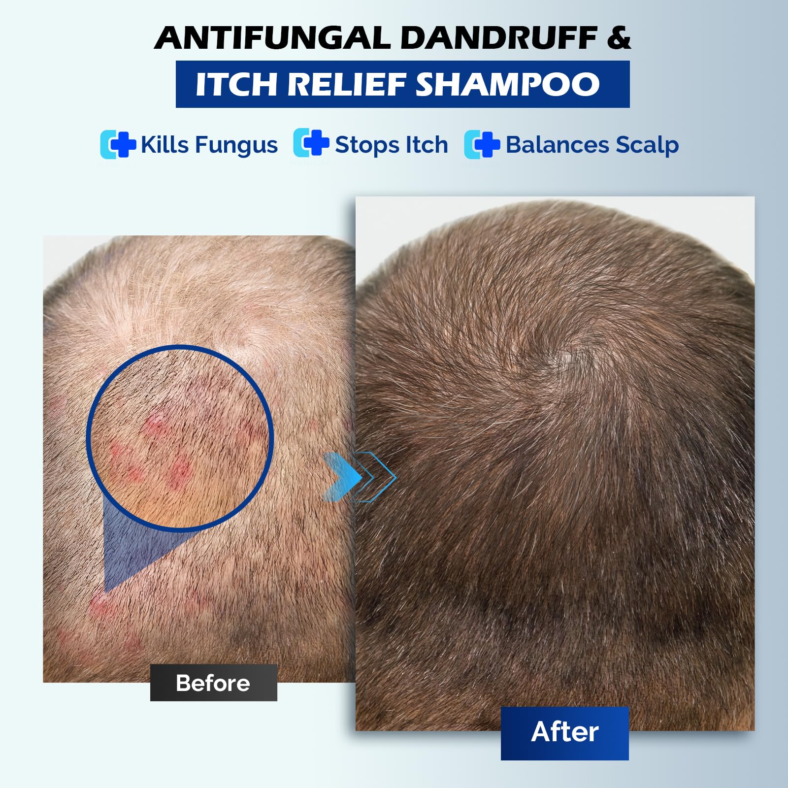 Oely Anti-Dandruff Shampoo for Folliculitis & Scalp Psoriasis | 10.1 fl oz