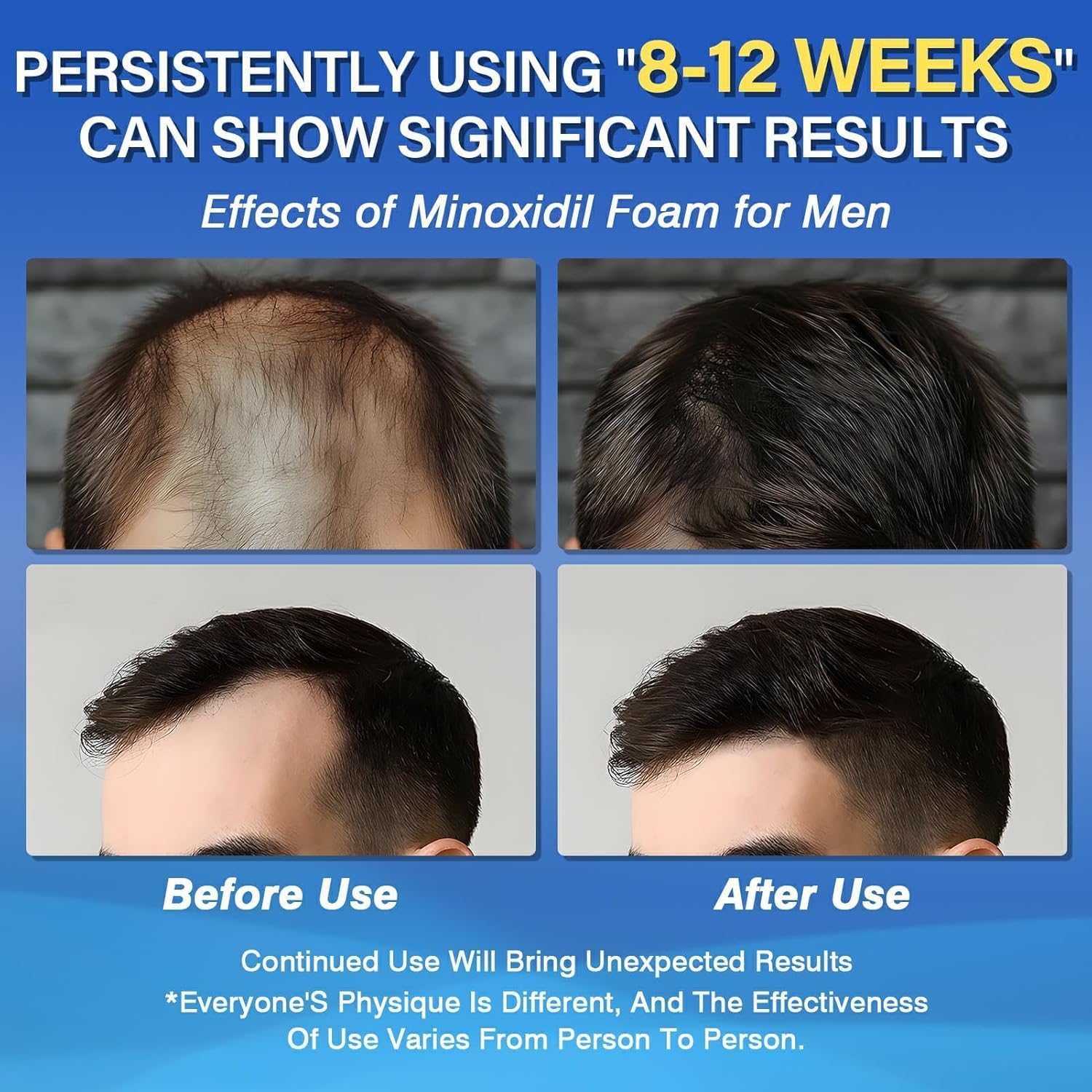 Olassubd Minoxidil 5% Foam for Men – Hair Growth Foam (3 Bottles, 2.11 oz Each)