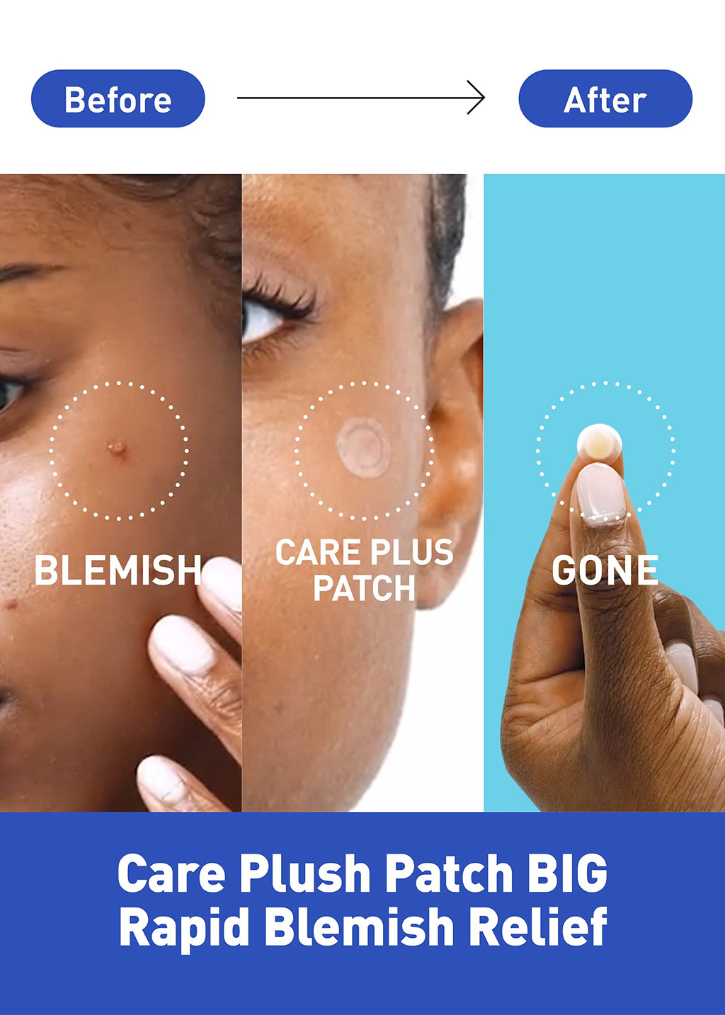 OLIVE YOUNG Care Plus Spot Patch Big (81 Count) – Hydrocolloid Acne Patches