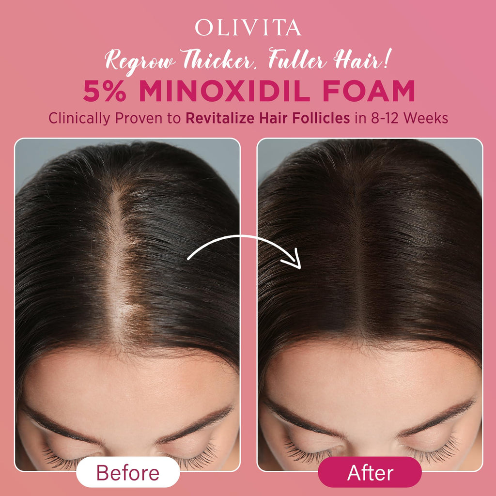 OLIVITA 5% Minoxidil Foam for Women – Extra Strength Hair Regrowth (2-Pack)