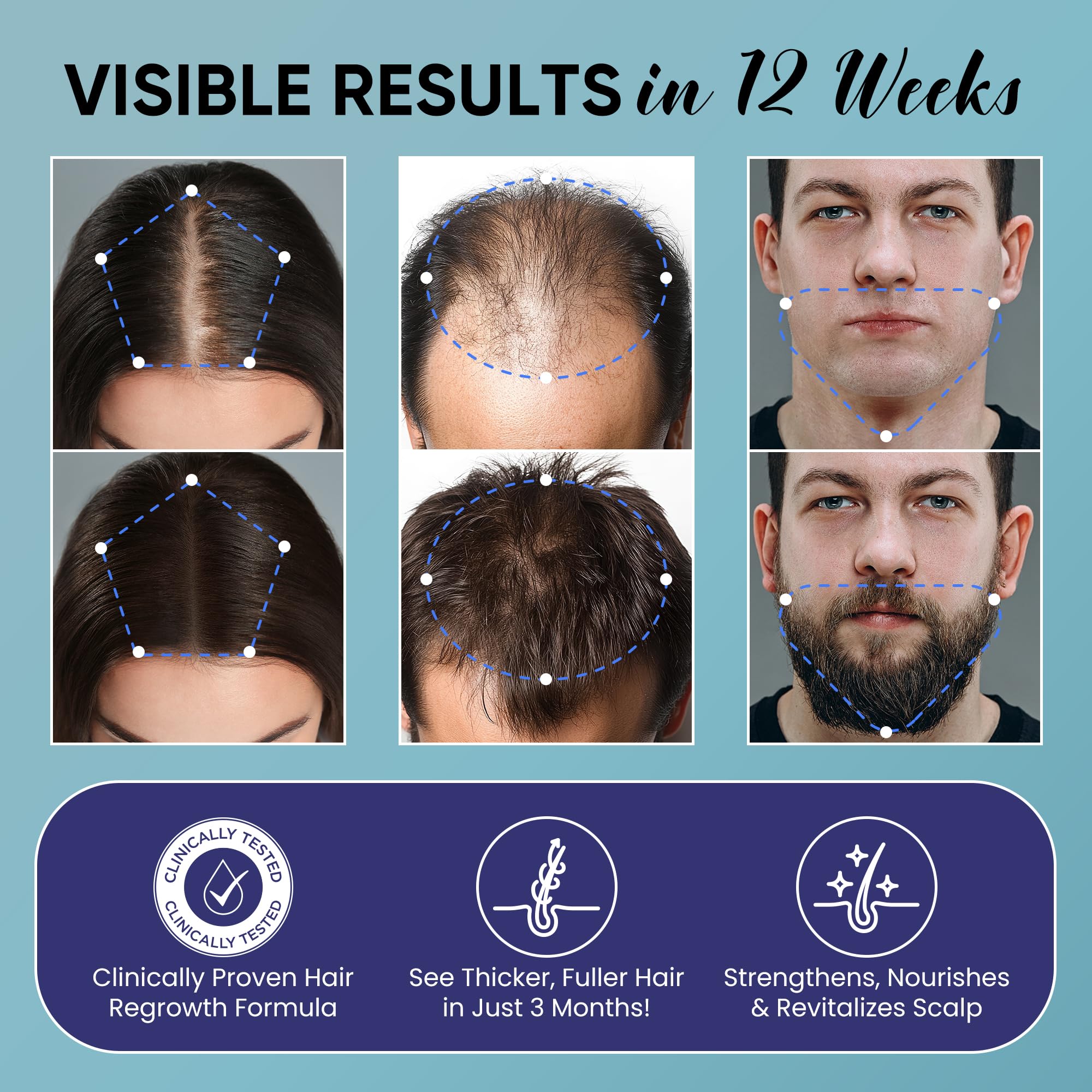 OLIVITA 5% Minoxidil Hair Growth Kit – For Men & Women with Biotin & Rosemary