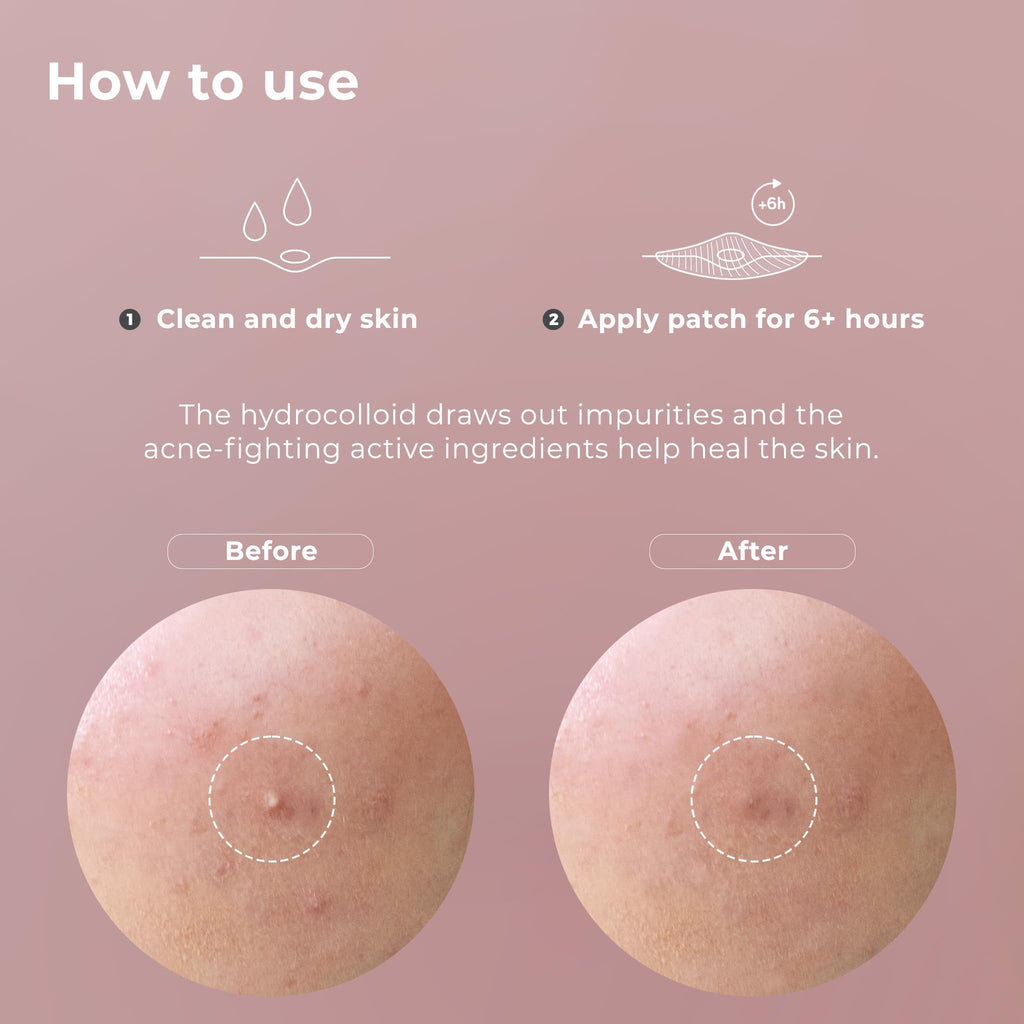 OMMA Korean Pimple Patches – Hydrocolloid Acne Dots, 72 Count, 10mm, Salicylic Acid