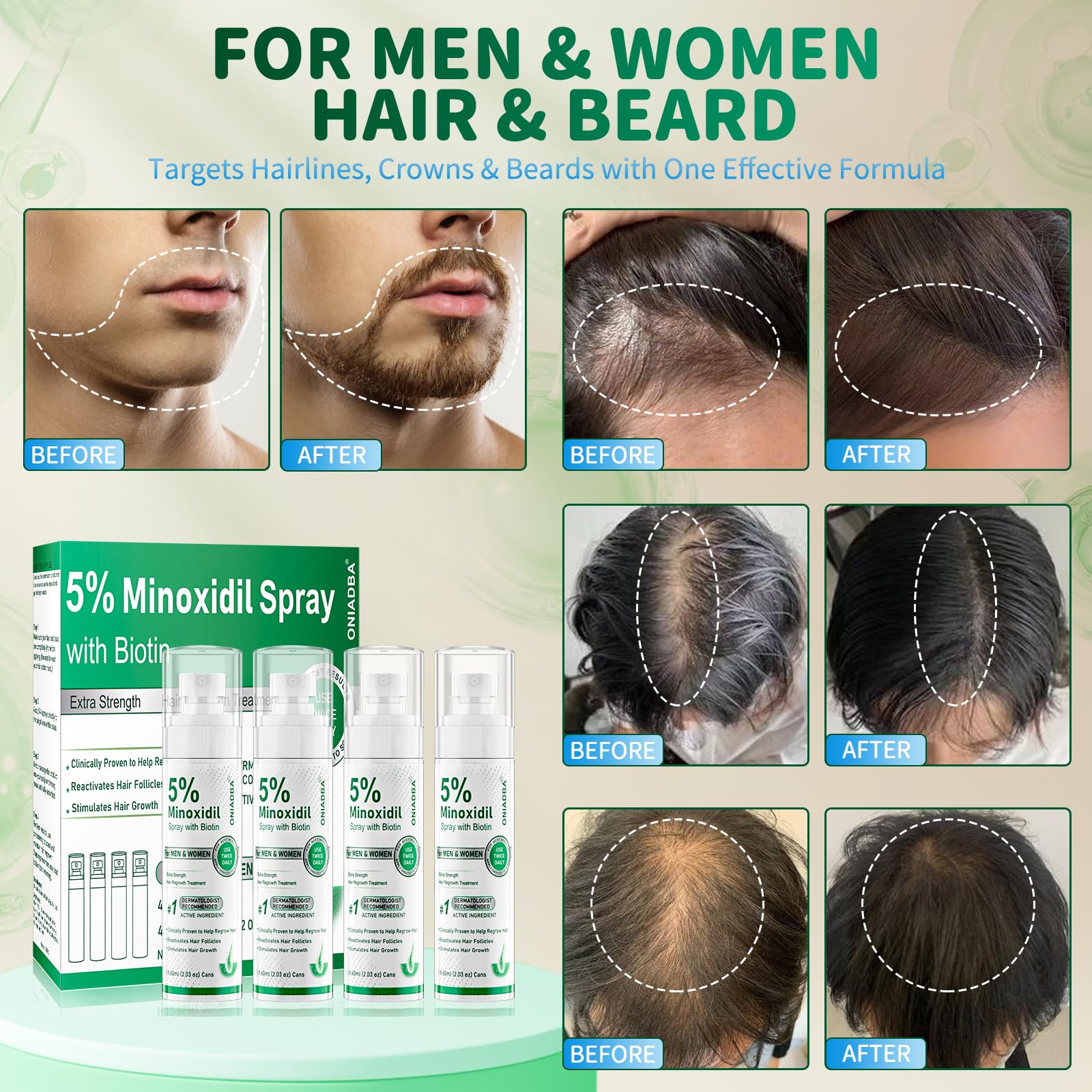 ONIADBA 5% Minoxidil Spray for Hair Growth – 4 Pack (8.12 oz each)