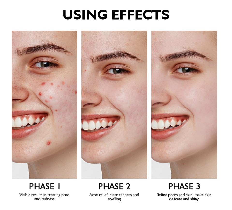 Onkessy Azelaic Acid Serum — 10% Azelaic + Salicylic Acid for Acne & Pore Refinement, 30ml