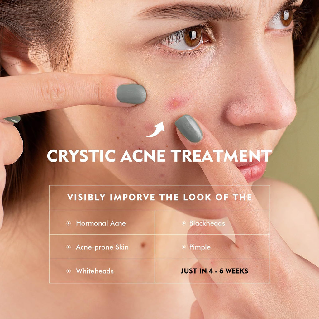 Onkessy Azelaic Acid Serum — 10% Azelaic + Salicylic Acid for Acne & Pore Refinement, 30ml
