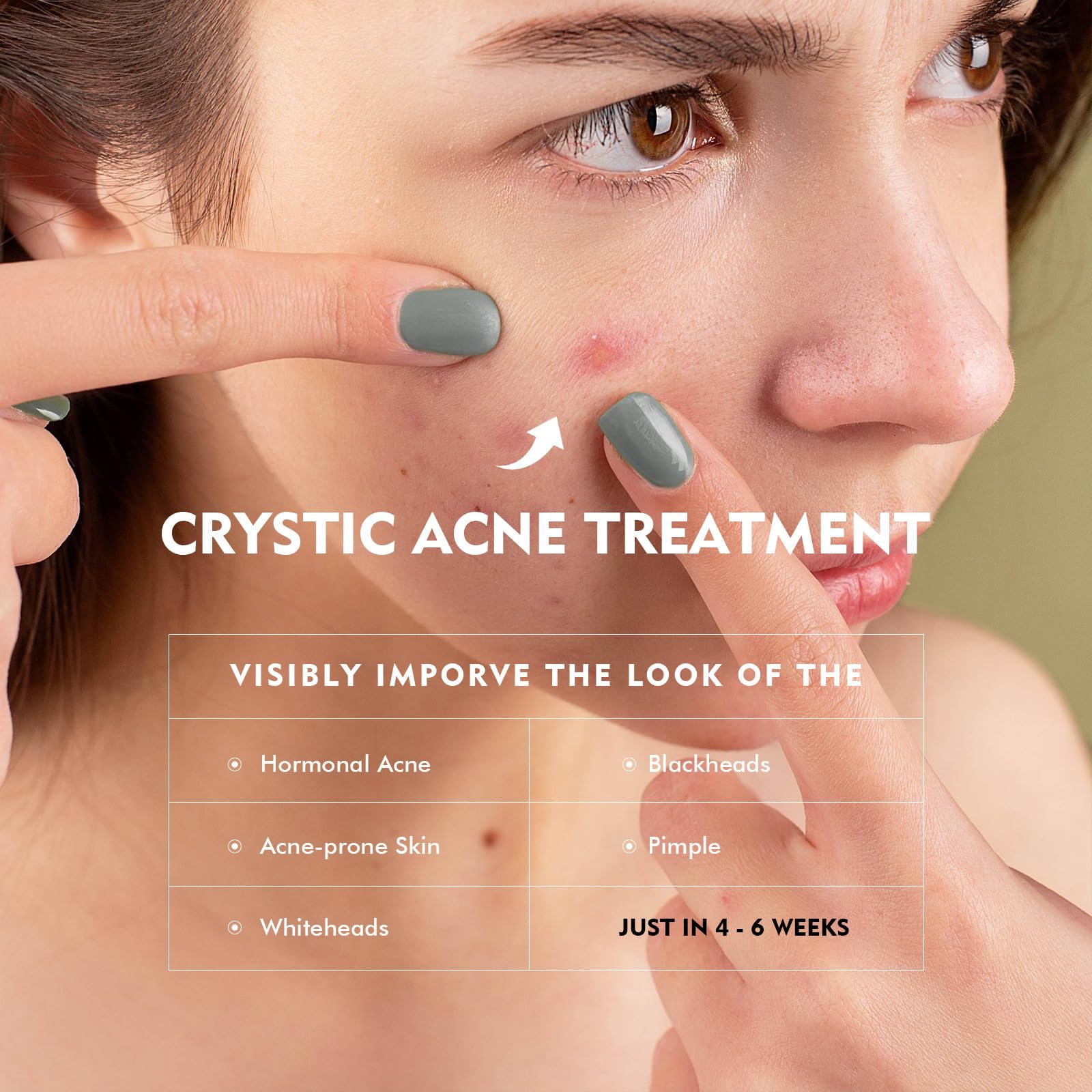Onkessy Azelaic Acid Serum — 10% Azelaic + Salicylic Acid for Acne & Pore Refinement, 30ml