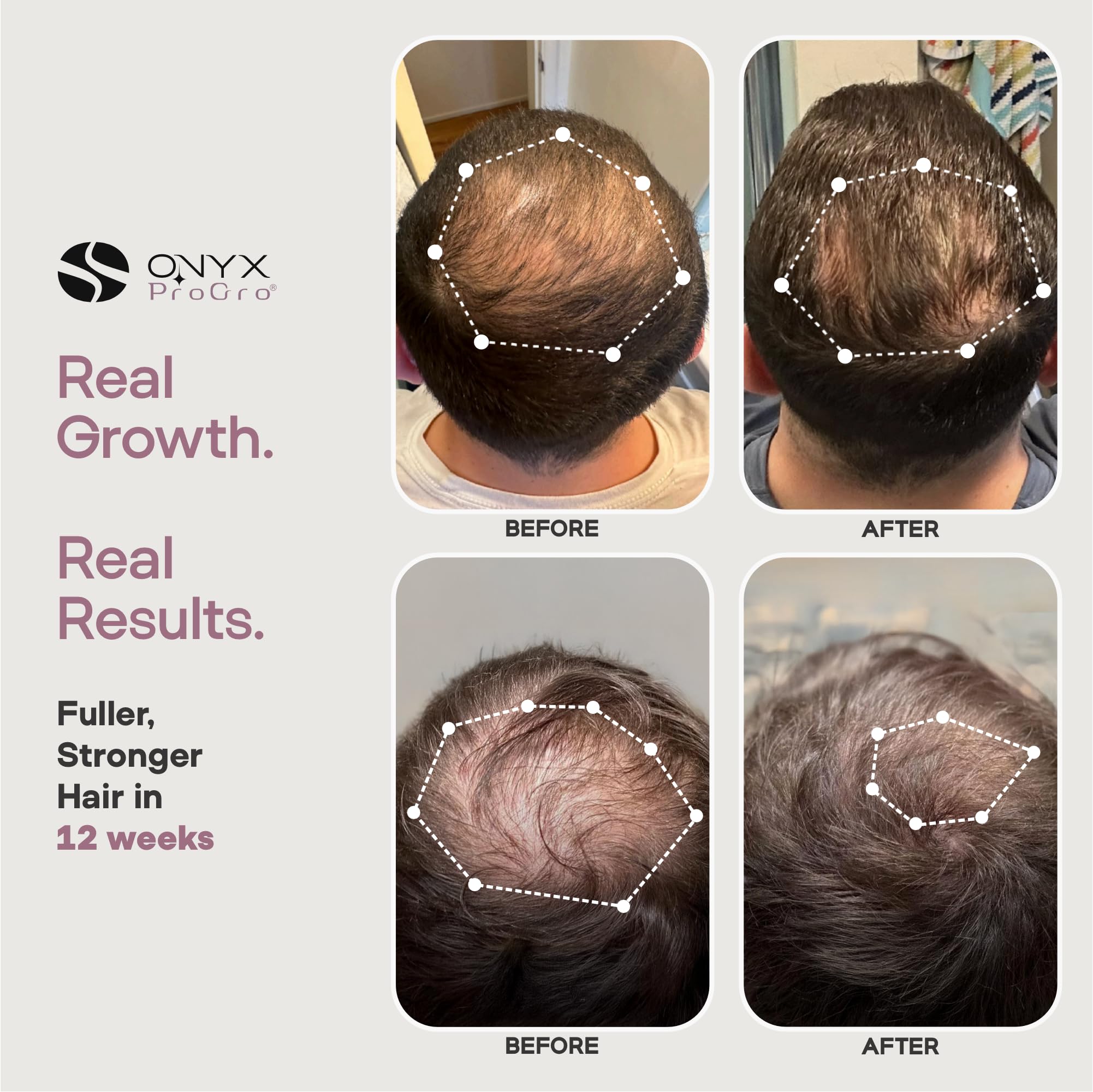 ONYX ProGro LactoPherma Hair Growth Serum – Oil-Free, 12-Ingredient Formula for Regrowth & Thickening