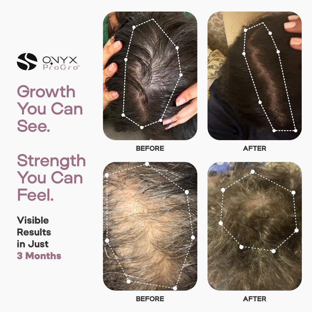 ONYX ProGro LactoPherma Hair Growth Serum – Oil-Free, 12-Ingredient Formula for Regrowth & Thickening