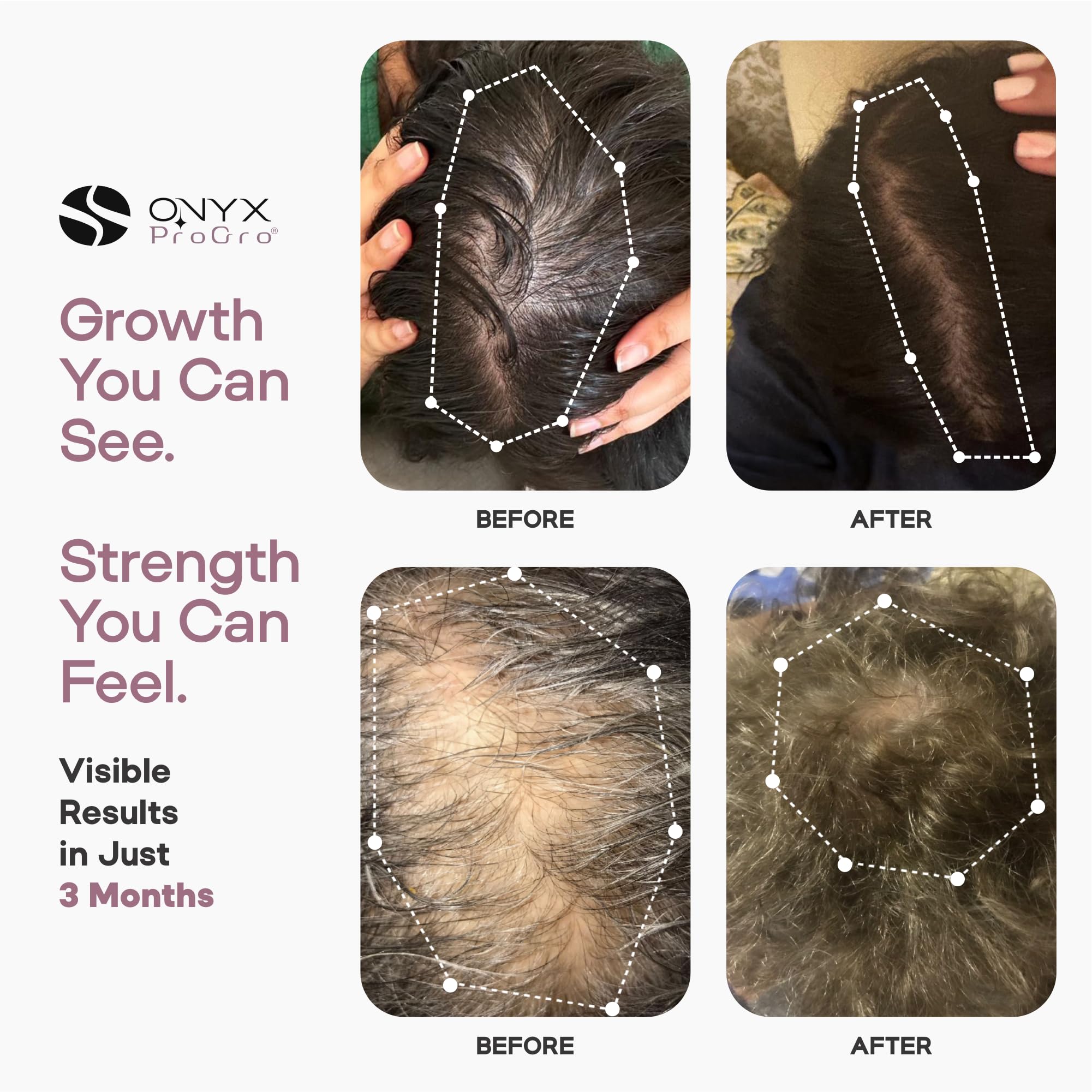 ONYX ProGro LactoPherma Hair Growth Serum – Oil-Free, 12-Ingredient Formula for Regrowth & Thickening