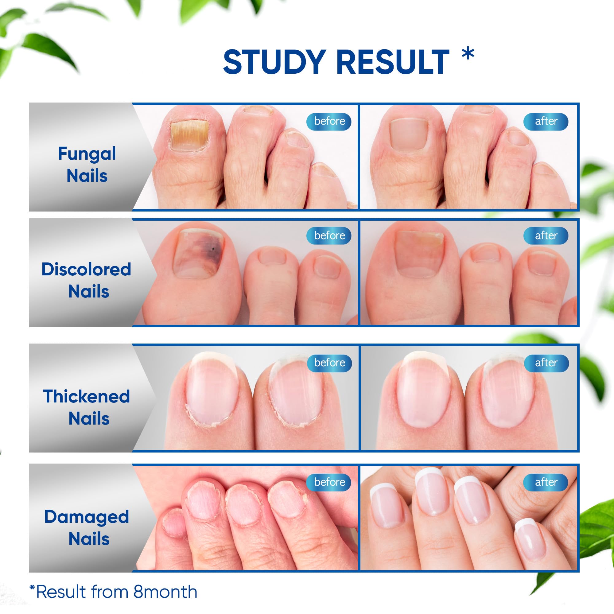 OSIMOON Fungus Treatment for Toenails – Extra Strength, Fast Acting, 2-Pack
