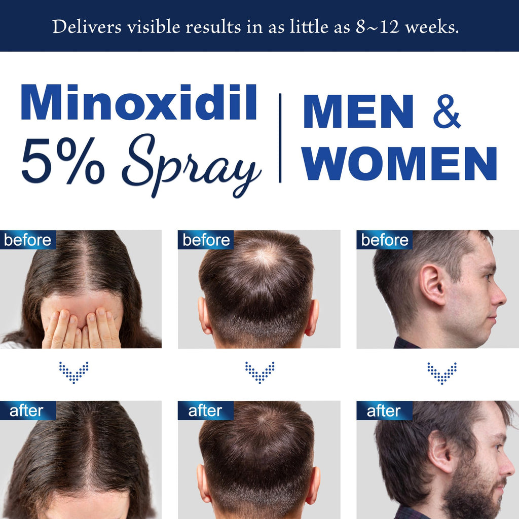 OSIMOON 5% Minoxidil Hair Growth Spray for Men & Women – 180ml
