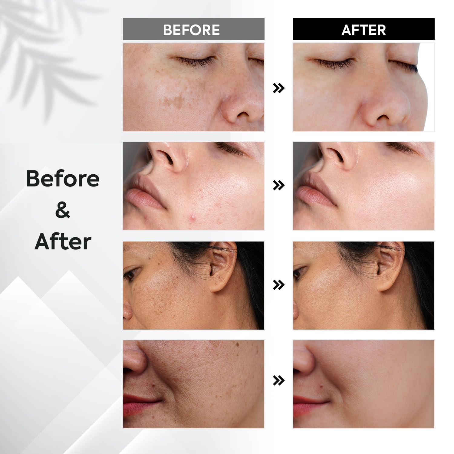 Oudetas Dark Spot Remover for Face – Brightening Serum Roller (15ml) for Sun, Age Spots & Melasma