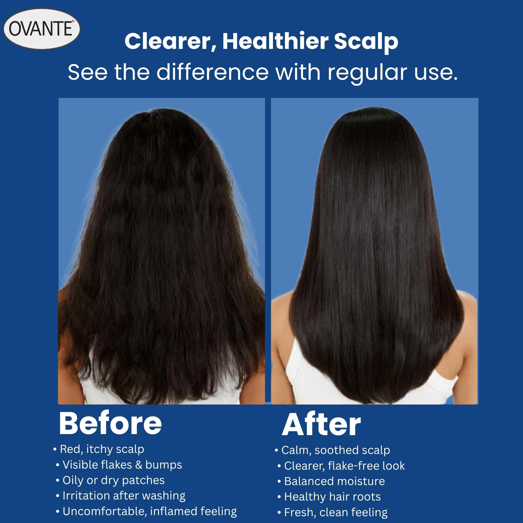 OVANTE Folliculitis Shampoo – Tea Tree Scalp Cleanser (6 oz)