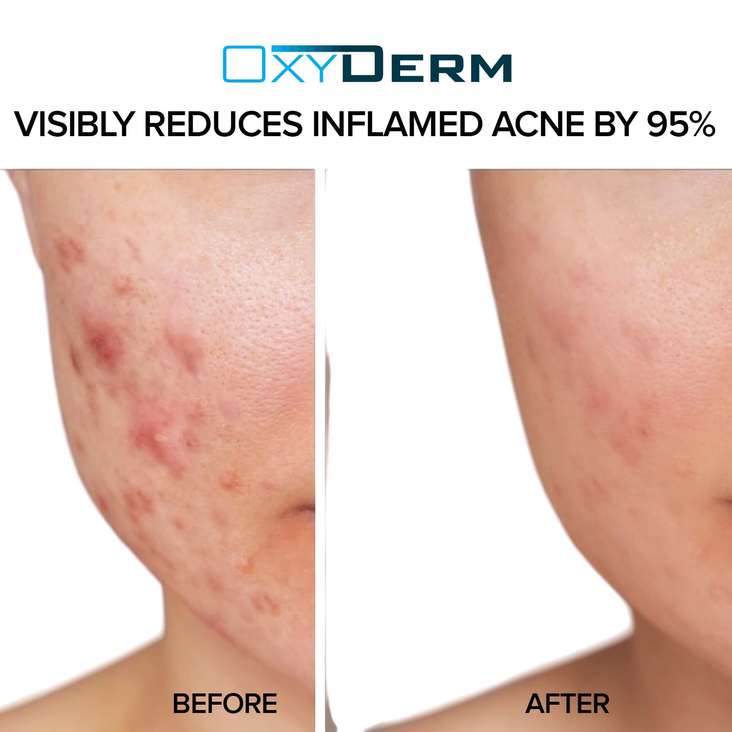 OxyDerm Acne Treatment Pads – Clear Pores, Reduce Blemishes & Breakouts | 60 Count