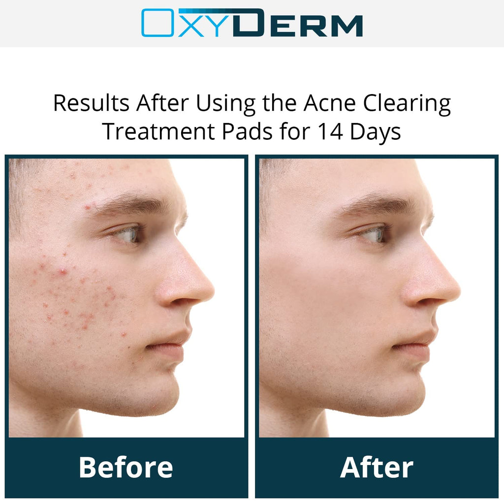 OxyDerm Acne Treatment Pads – Clear Pores, Reduce Blemishes & Breakouts | 60 Count
