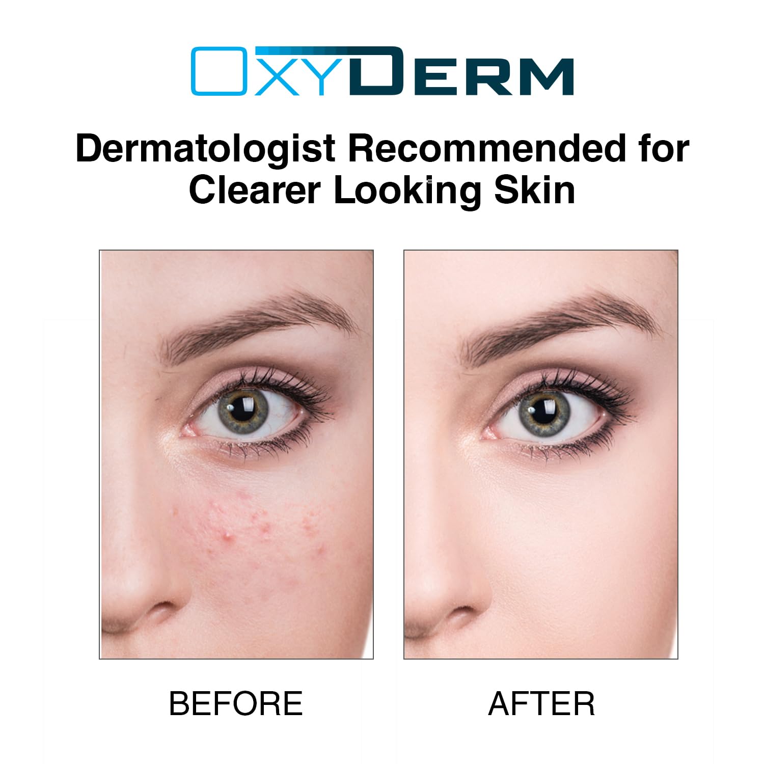 OxyDerm Acne Treatment Pads – Clear Pores, Reduce Blemishes & Breakouts | 60 Count