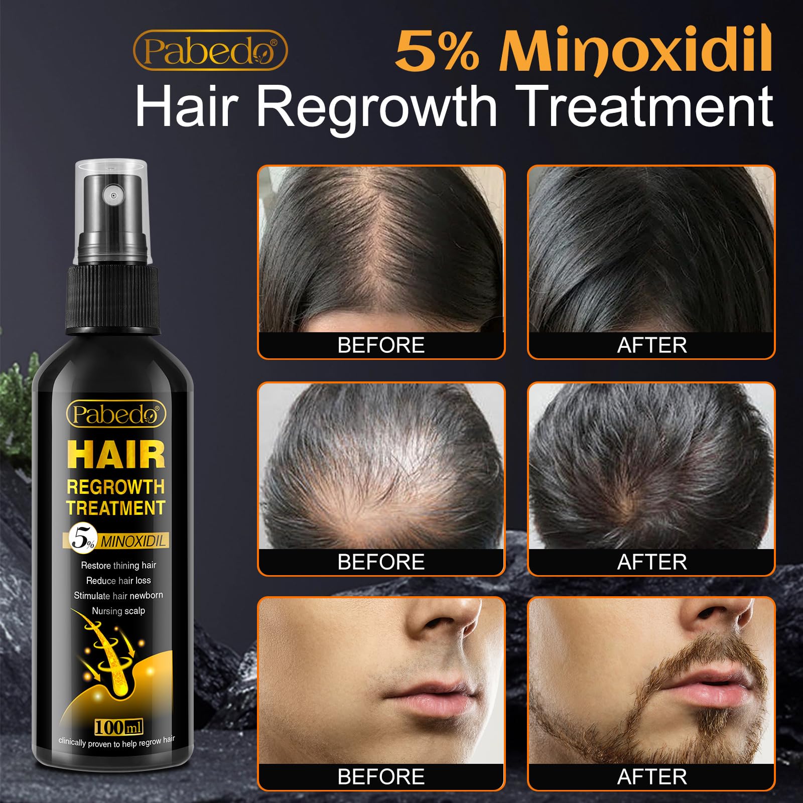 Pabedo 5% Minoxidil Hair Growth Spray for Beard & Hair — 3.38 oz
