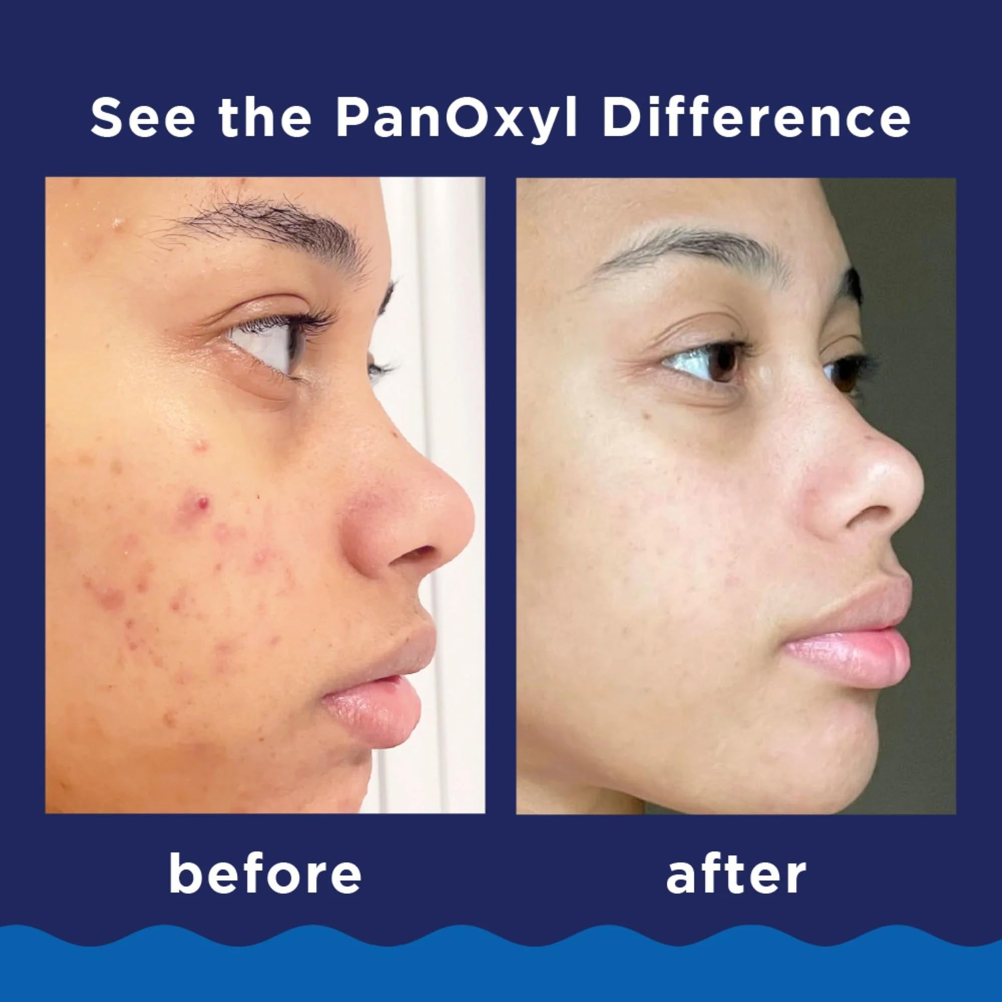 PanOxyl Foaming Acne Wash Maximum Strength 5.5 oz (Pack of 6)