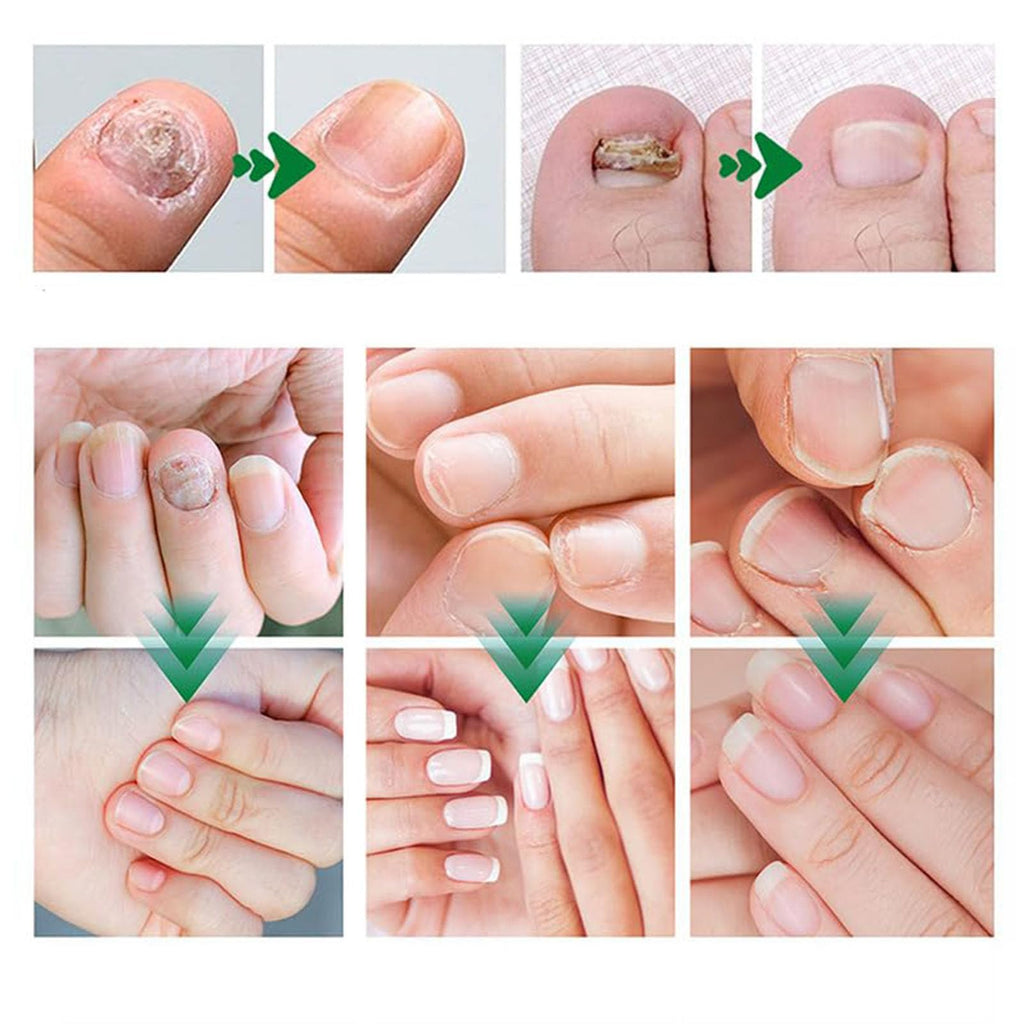 PARWENE Natural Nail Treatment Gel – Nail Growth Serum for Repair & Strengthening (20 ml)