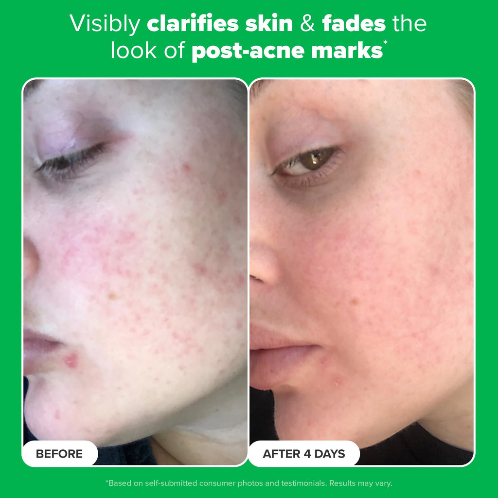 Paula's Choice BOOST 10% Azelaic Acid Booster Cream-Gel – Oil-Free Serum with Salicylic Acid