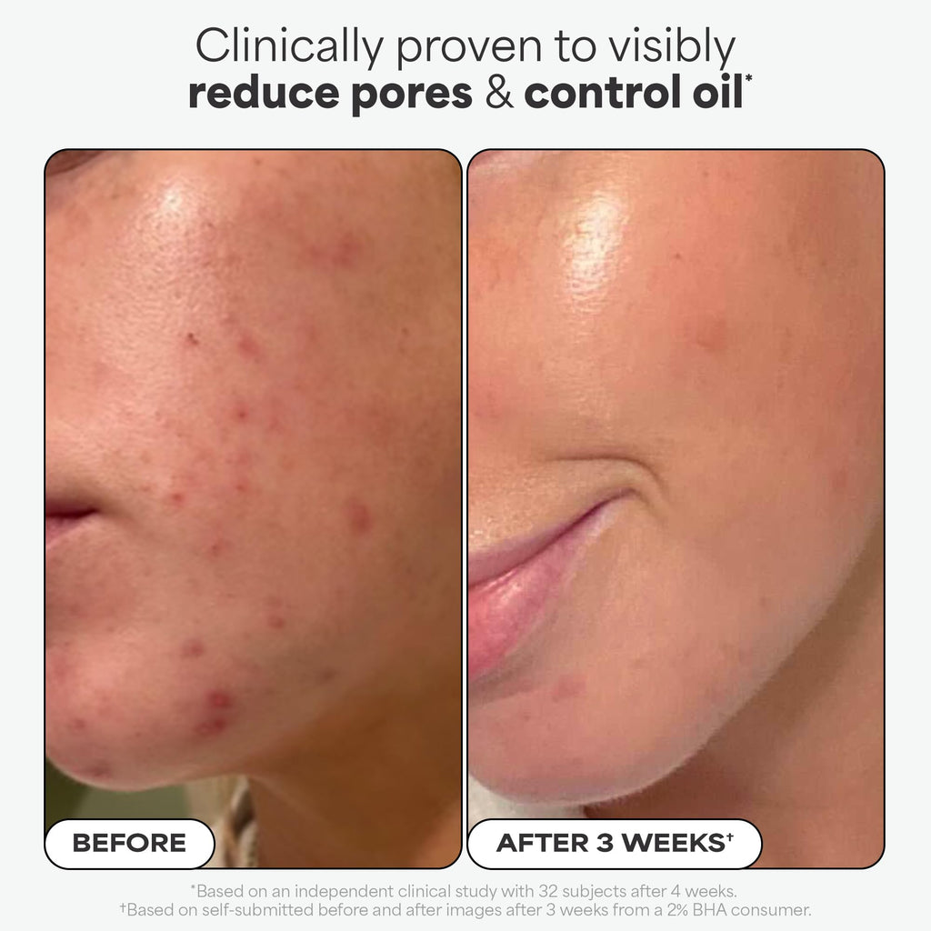 Paula's Choice SKIN PERFECTING 2% BHA Liquid Exfoliant – Unclog Pores, Smooth Fine Lines, Fragrance-Free