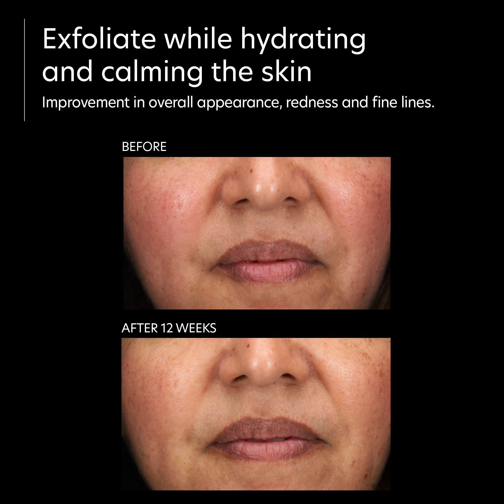 PCA SKIN Resurfacing Serum - Gentle Exfoliating Facial Corrective with Lactic & Glycolic Acid (1 fl oz)