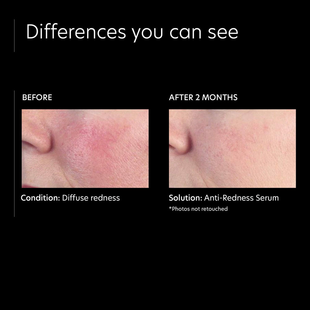 PCA SKIN Anti Redness Remover Face Serum – Oil-Free Calming Treatment (1 fl oz)