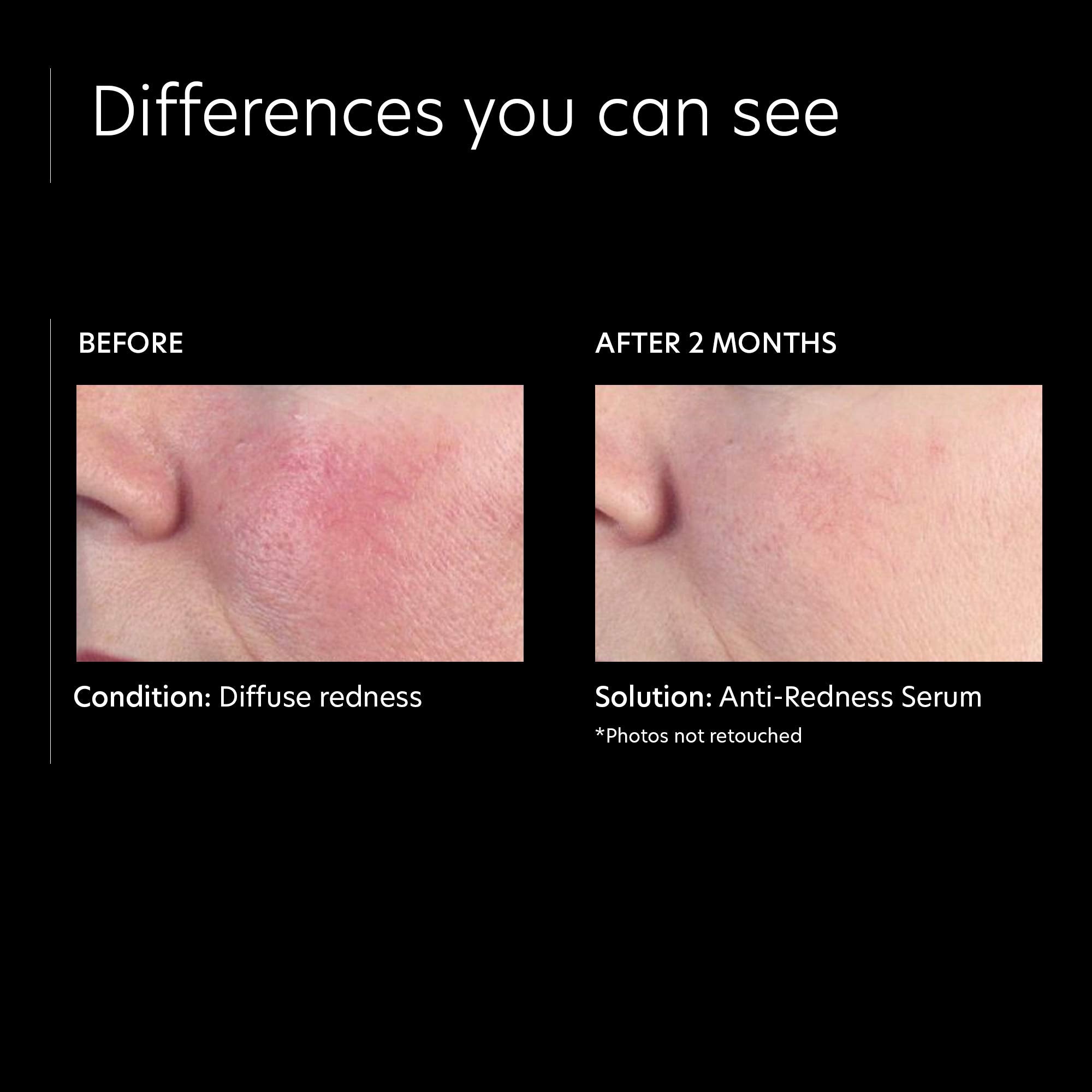 PCA SKIN Anti Redness Remover Face Serum – Oil-Free Calming Treatment (1 fl oz)