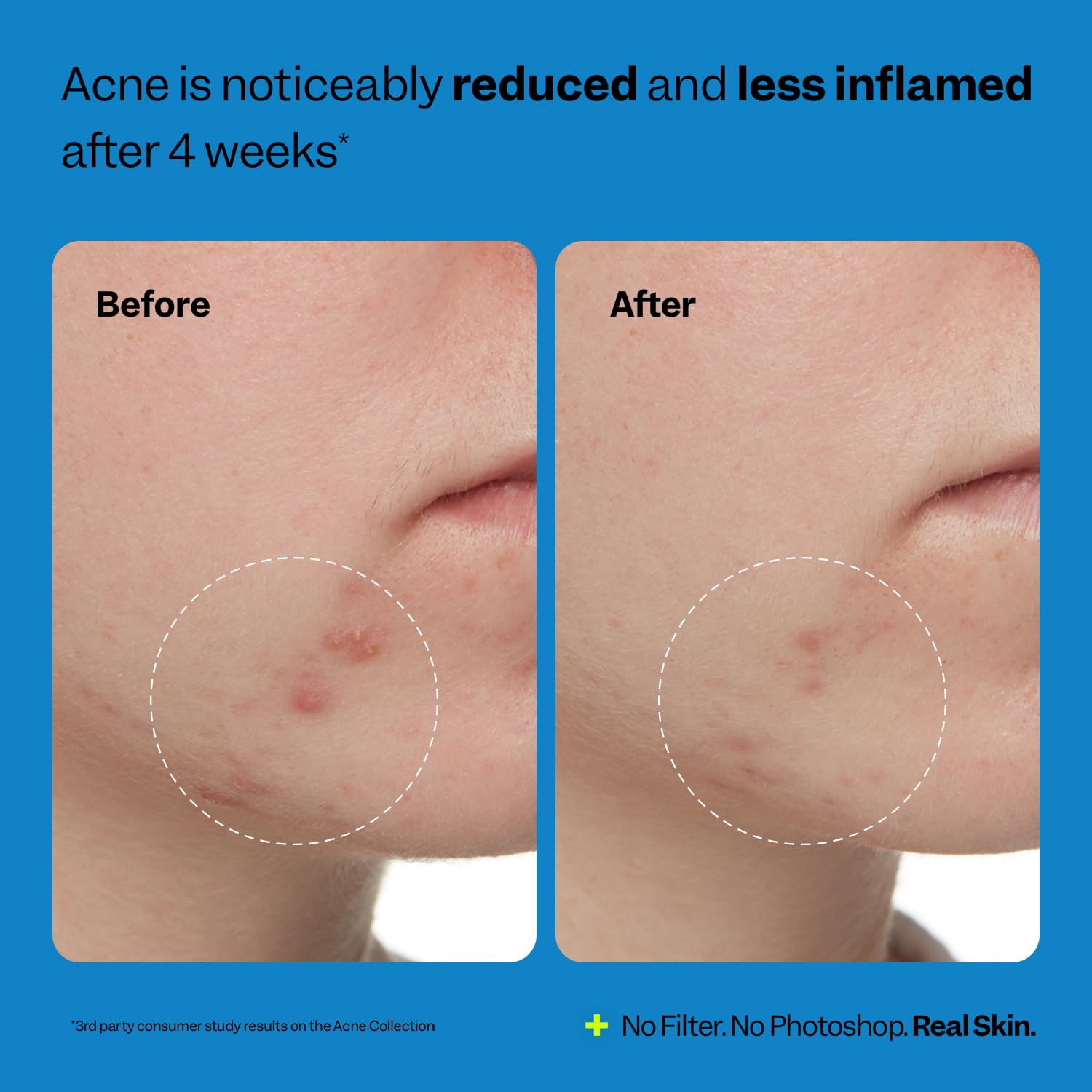 Peach Slices Acne Exfoliating Toner – 2% Salicylic, 4.05 oz – Clear & Prevent Breakouts